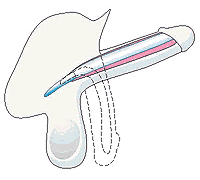 semirigide Prothese